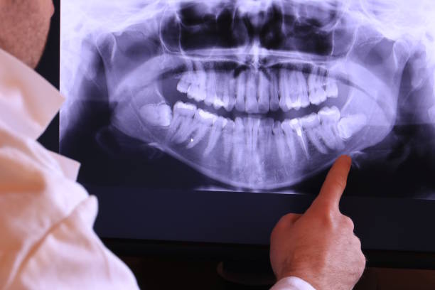 Best Emergency Tooth Extraction in Califon, NJ
