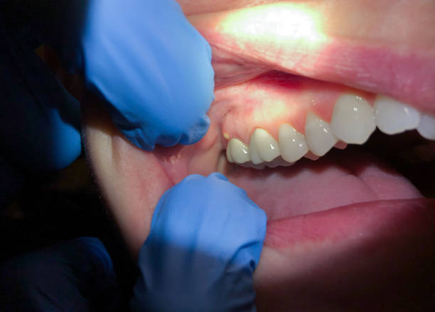 Best Emergency Denture Repair in Califon, NJ