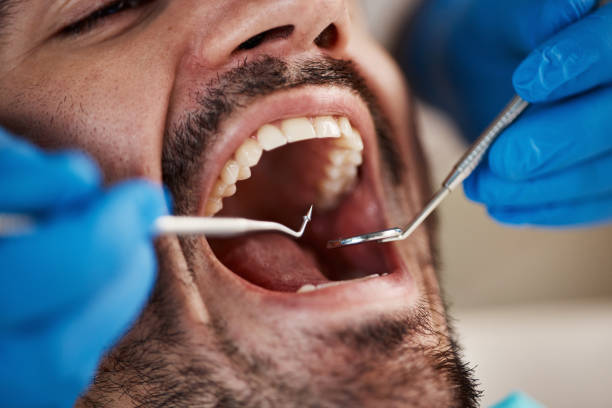 Best Emergency Dental Care for Broken or Chipped Teeth in Califon, NJ